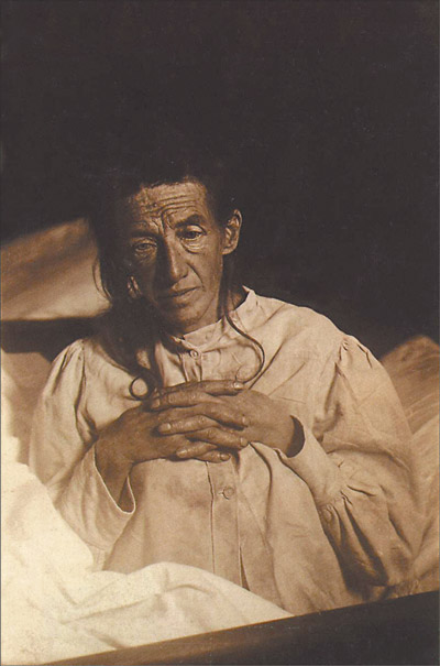 Auguste Deter. Alois Alzheimer's patient in November 1901, first described patient with Alzheimer's Disease.